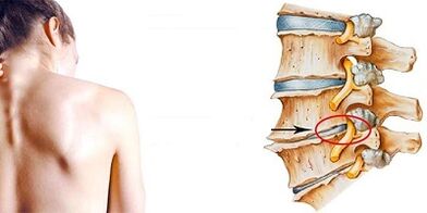 Osteokondrosis cervikala garatzeko mekanismoa