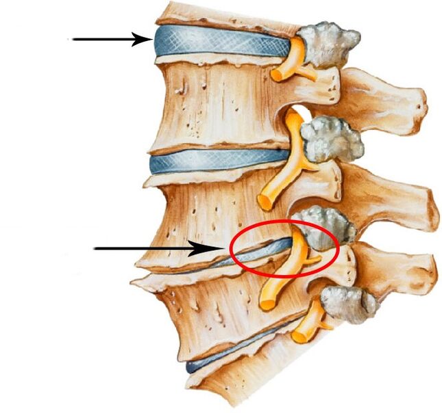 Disko hernia garatzea