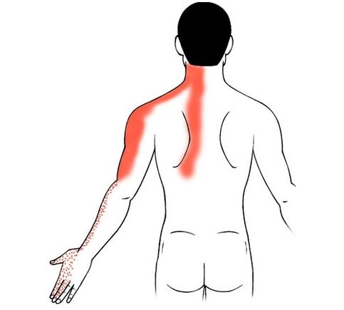 cervical osteocondrosis hatz artikulazioetan minaren kausa gisa