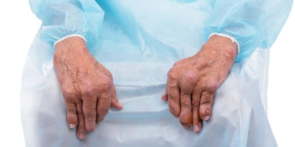 Artritis infekziosoa hatz artikulazioetan etengabeko mina eta aldaketak dituen gaixotasuna da.