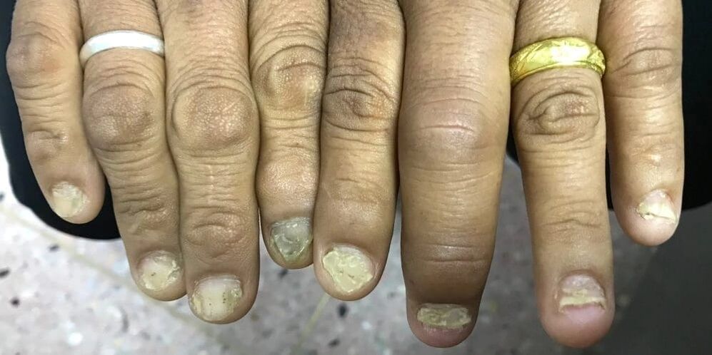 Behatzen hanturak eta iltze-plakaren deformazioak artritis psoriasikoaren garapena adieraz dezakete.